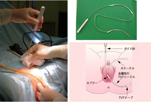 図３　腹部からのアプローチによるTVT手術