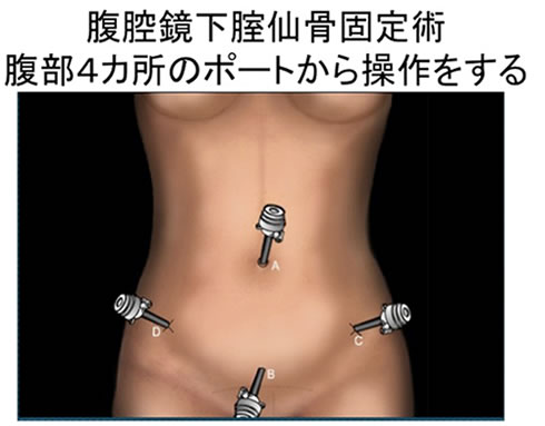 腹腔鏡下膣仙骨		固定術　腹部の４ヶ所のポートから操作をする