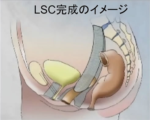 LSC完成のイメージ