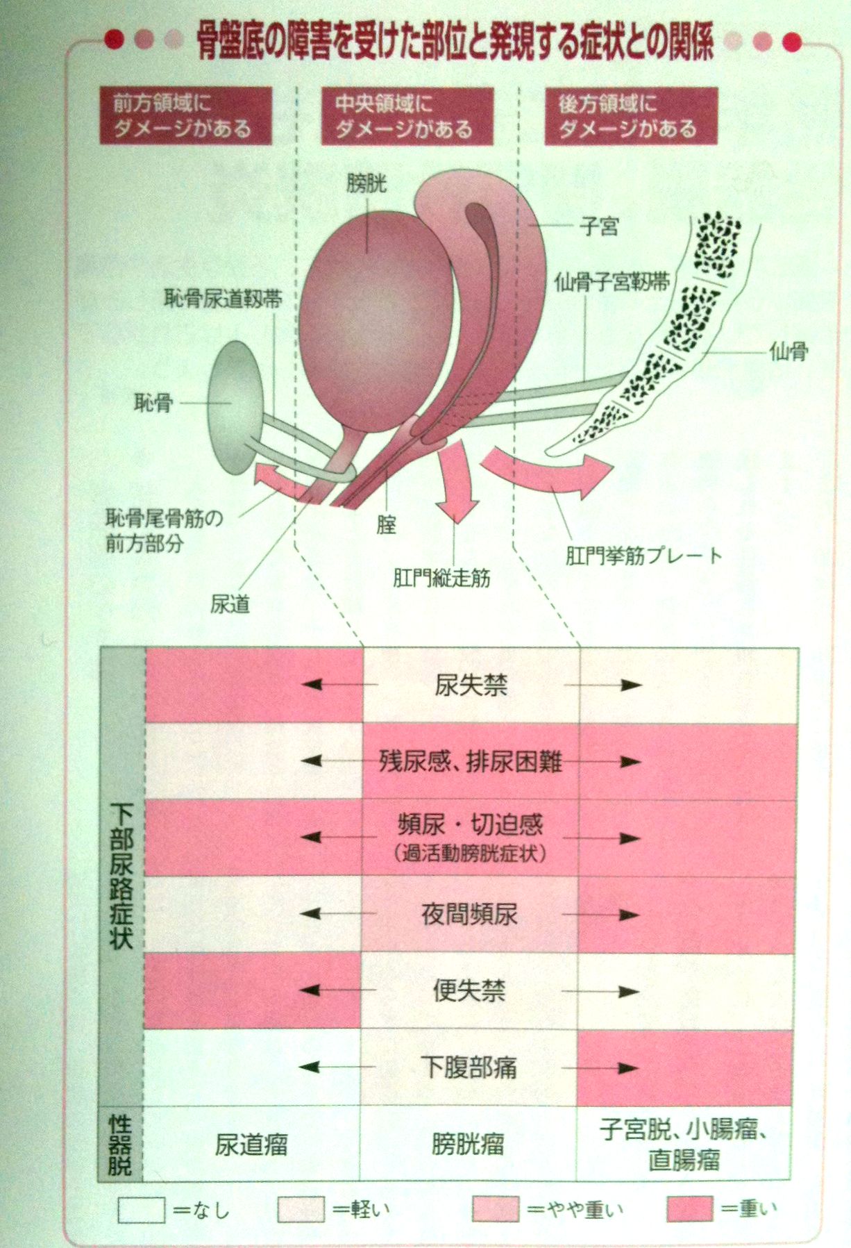 骨盤臓器脱 子宮脱 手術 Net 女性泌尿器科百科 ７ 骨盤臓器脱の治療その１